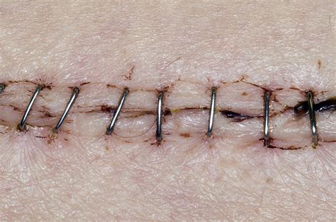 How long should staples stay in a wound?